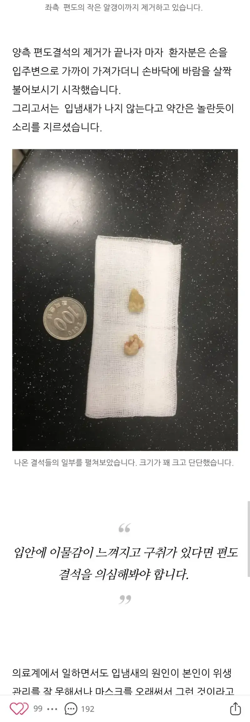 편도결석 ㄹㅈ�의 내용을 보여주는 이미지