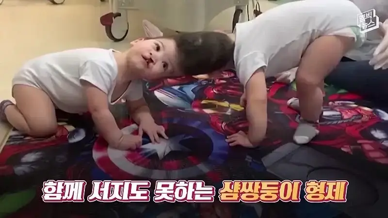 33시간 수술 끝에 얼굴 본 쌍둥이.jpg
