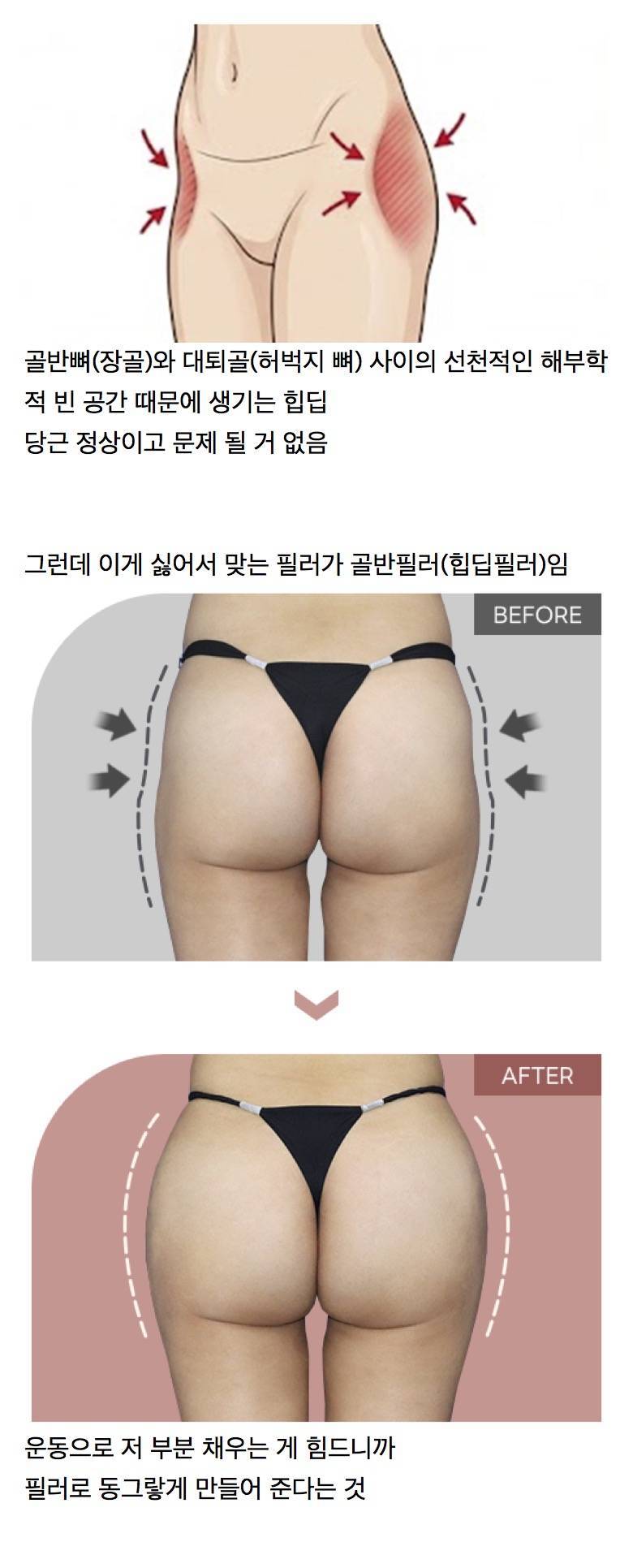 이름 바꿔서 한국에 들어온 BBL(엉덩이 키우기) 수술의 내용을 보여주는 이미지