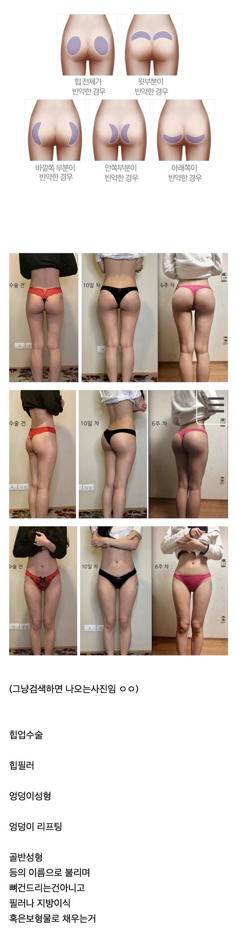 이름 바꿔서 한국에 들어온 BBL(엉덩이 키우기) 수술의 내용을 보여주는 이미지 관련 이미지 2