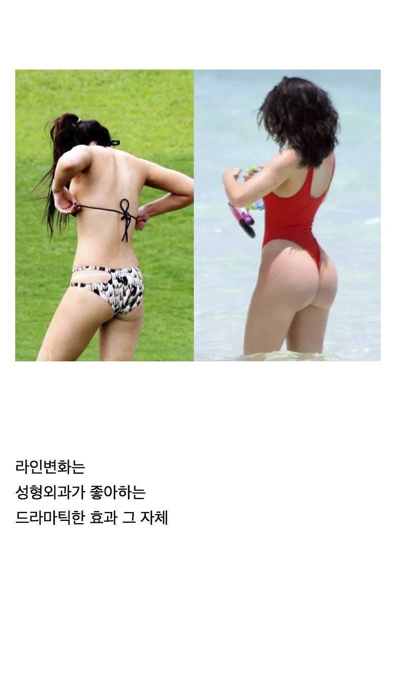 이름 바꿔서 한국에 들어온 BBL(엉덩이 키우기) 수술의 내용을 보여주는 이미지 관련 이미지 3