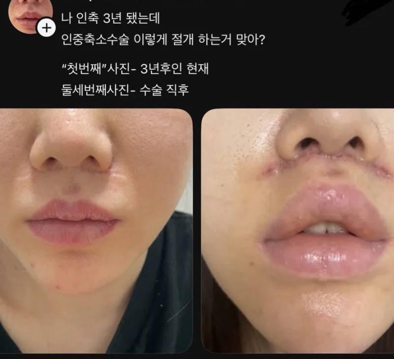 인중축소수술 3년 후 결과의 내용을 보여주는 이미지