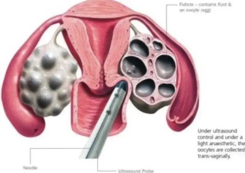 난자 채취할때 넣는 바늘 크기의 내용을 보여주는 이미지 관련 이미지 2