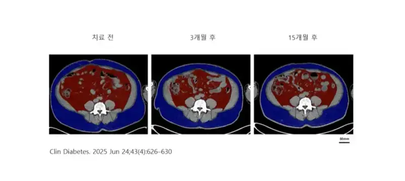 추적