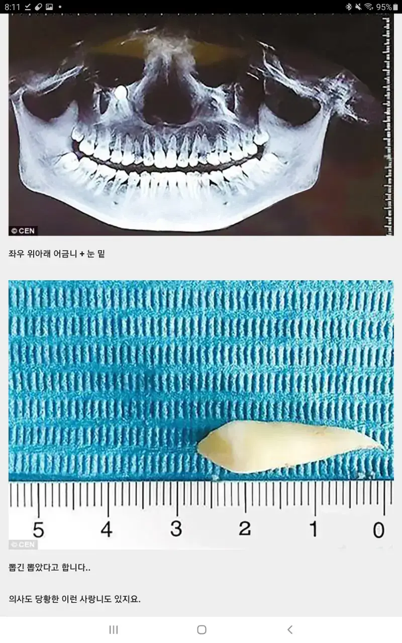 전생 매국노 사랑니 모음의 내용을 보여주는 이미지 관련 이미지 3
