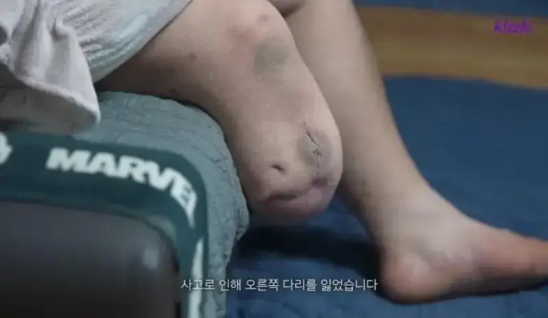 사고로 다리가 절단된 조선업 청년의 내용을 보여주는 이미지 관련 이미지 4