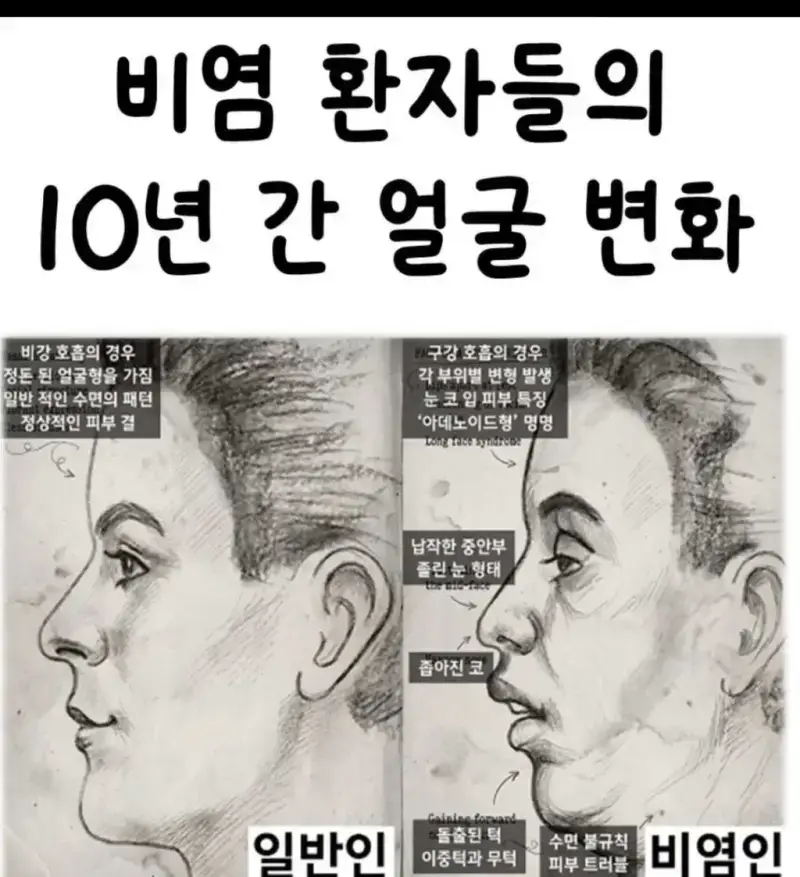 비염환자들의 10년간 얼굴 변화의 내용을 보여주는 이미지