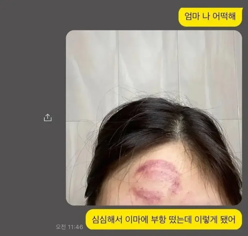 머리에 부황뜬 딸이 한심했던 어머니.JPG