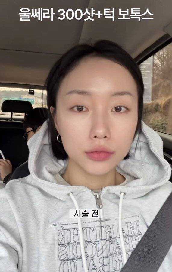 20~30대에 울쎄라 같은 시술 받는 거 안 좋다고 함의 내용을 보여주는 이미지