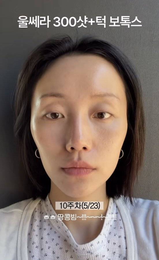20~30대에 울쎄라 같은 시술 받는 거 안 좋다고 함의 내용을 보여주는 이미지 관련 이미지 2