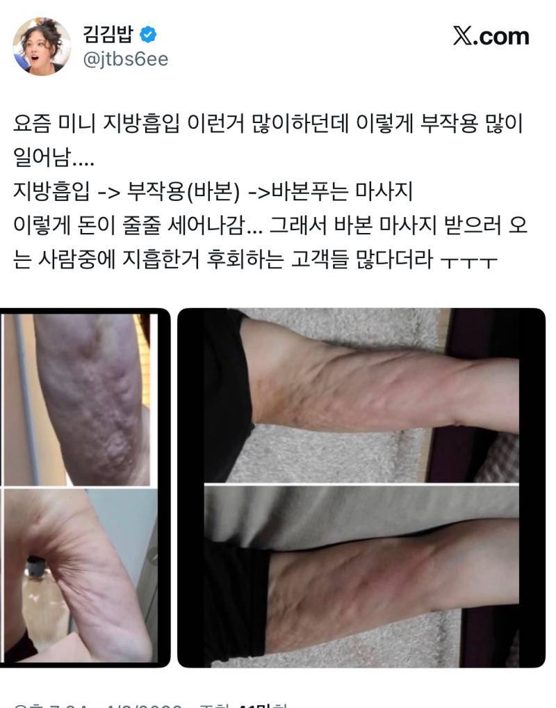 요즘 미니 지방흡입 이런거 많이하던데 이렇게 부작용 많이 일어남.의 내용을 보여주는 이미지