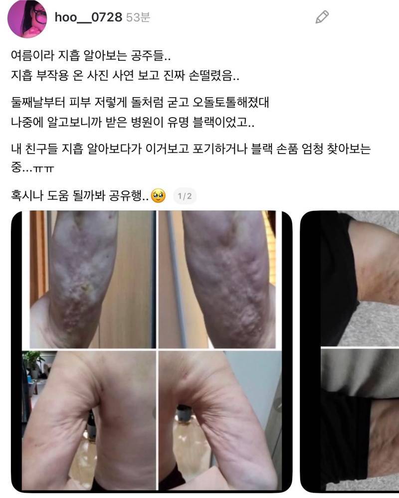 요즘 미니 지방흡입 이런거 많이하던데 이렇게 부작용 많이 일어남.의 내용을 보여주는 이미지 관련 이미지 2