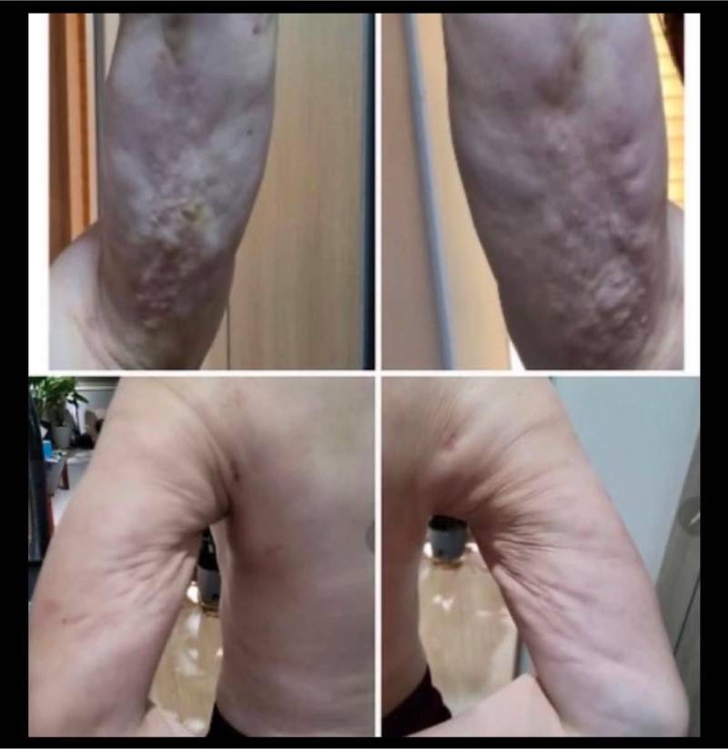 요즘 미니 지방흡입 이런거 많이하던데 이렇게 부작용 많이 일어남.의 내용을 보여주는 이미지 관련 이미지 3