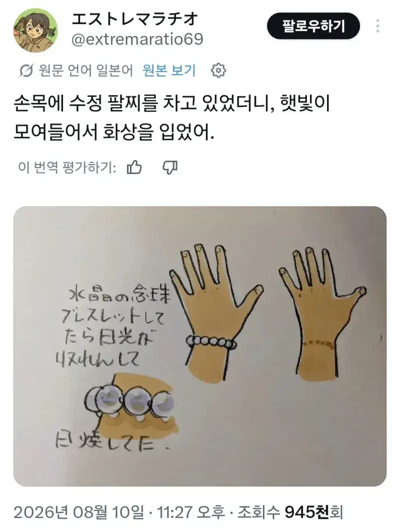 악세사리 때문에 손목에 화상 입음의 내용을 보여주는 이미지
